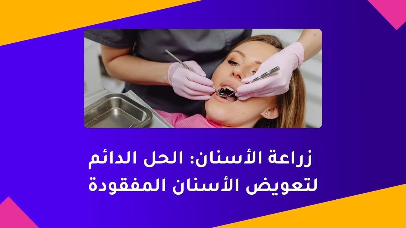 زراعة الأسنان: الحل الدائم لتعويض الأسنان المفقودة