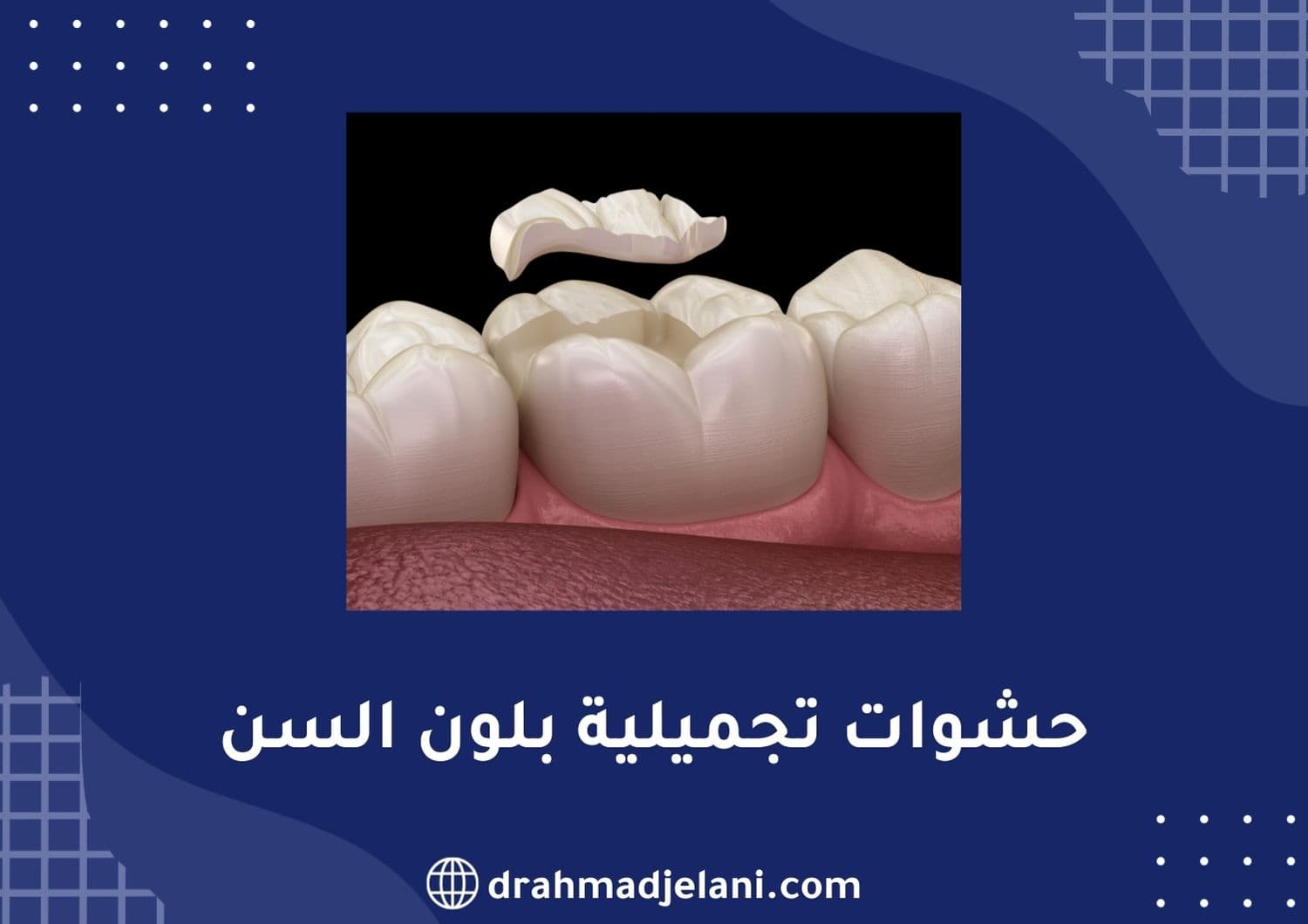 حشوات تجميلية بلون السن