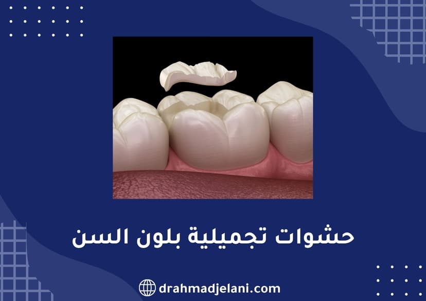 حشوات تجميلية بلون السن
