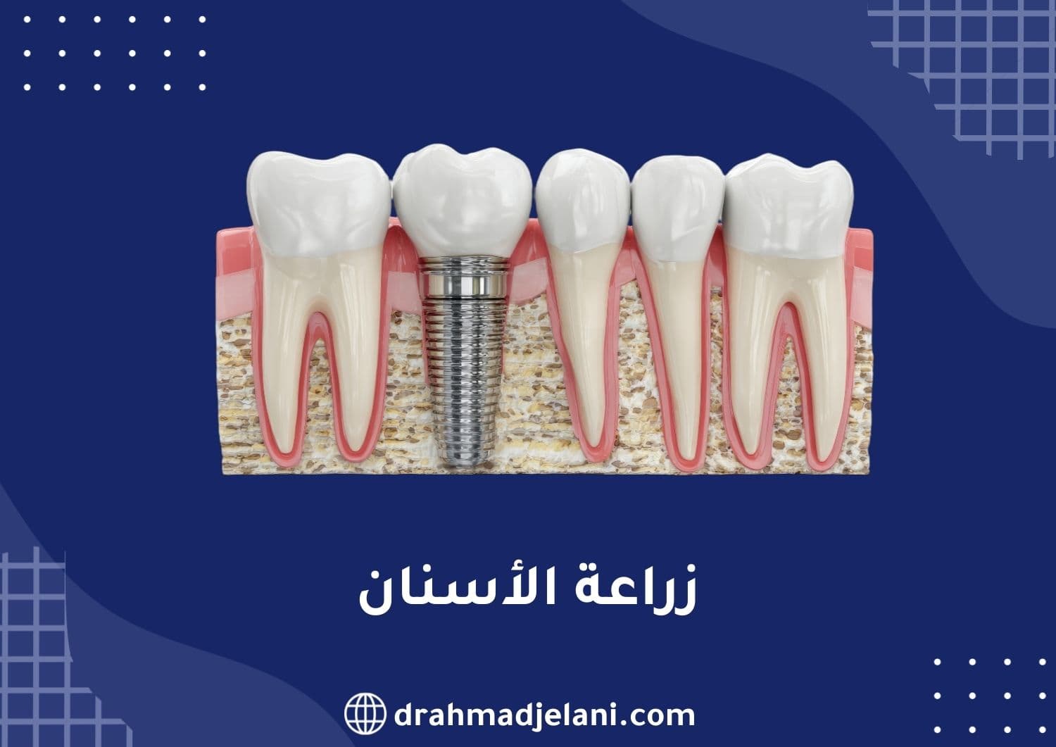 زراعة الأسنان